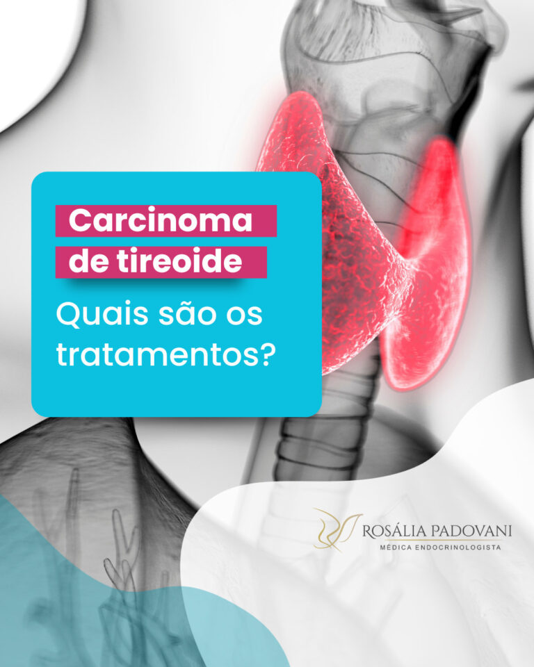 Carcinoma De Tireoide Quais São Os Tratamentos Dra Rosália Padovani 0054