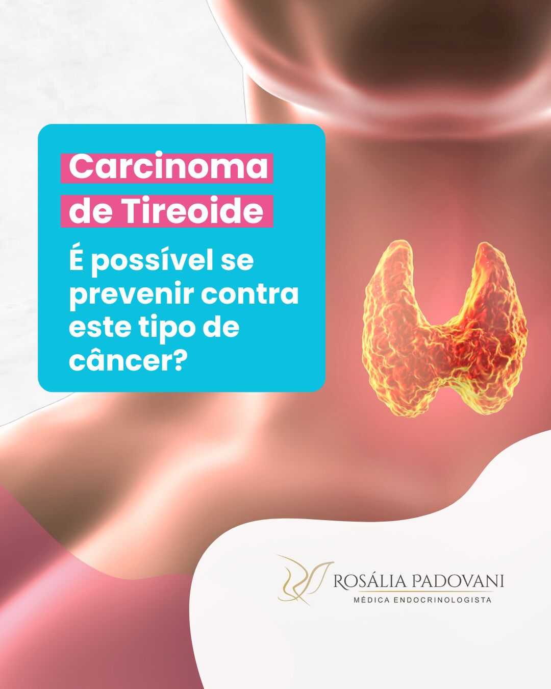 Leia mais sobre o artigo Carcinoma de Tireoide: É possível se prevenir contra este tipo de câncer?