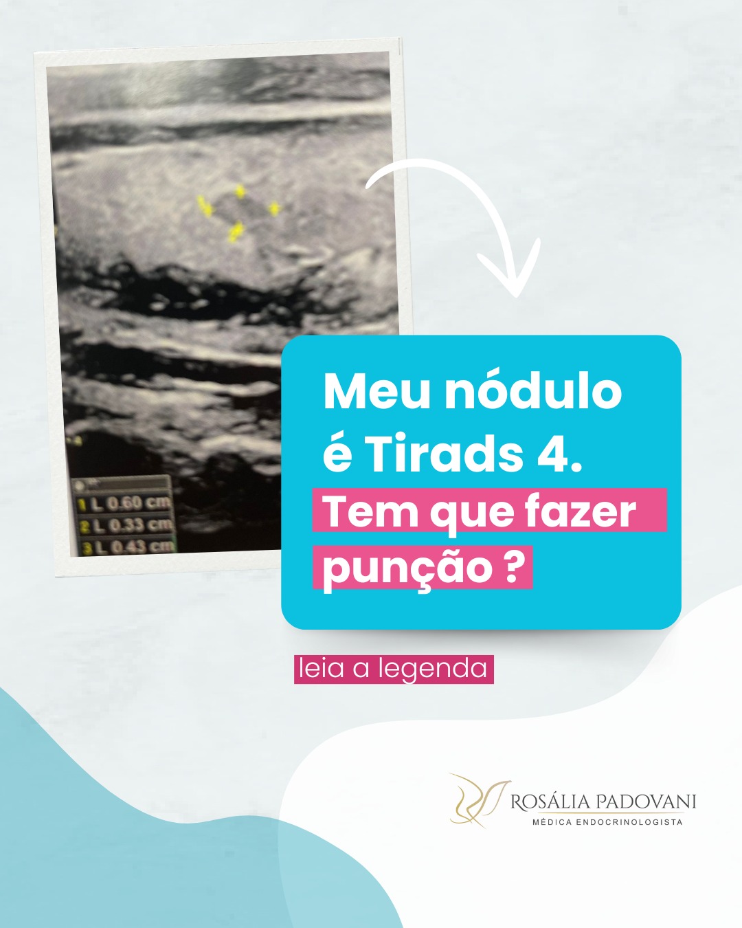 Leia mais sobre o artigo Meu nódulo é Tirads 4. Tem que fazer punção?