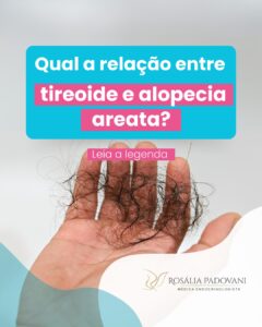 Leia mais sobre o artigo Qual a relação entre tireoide e alopecia areata?