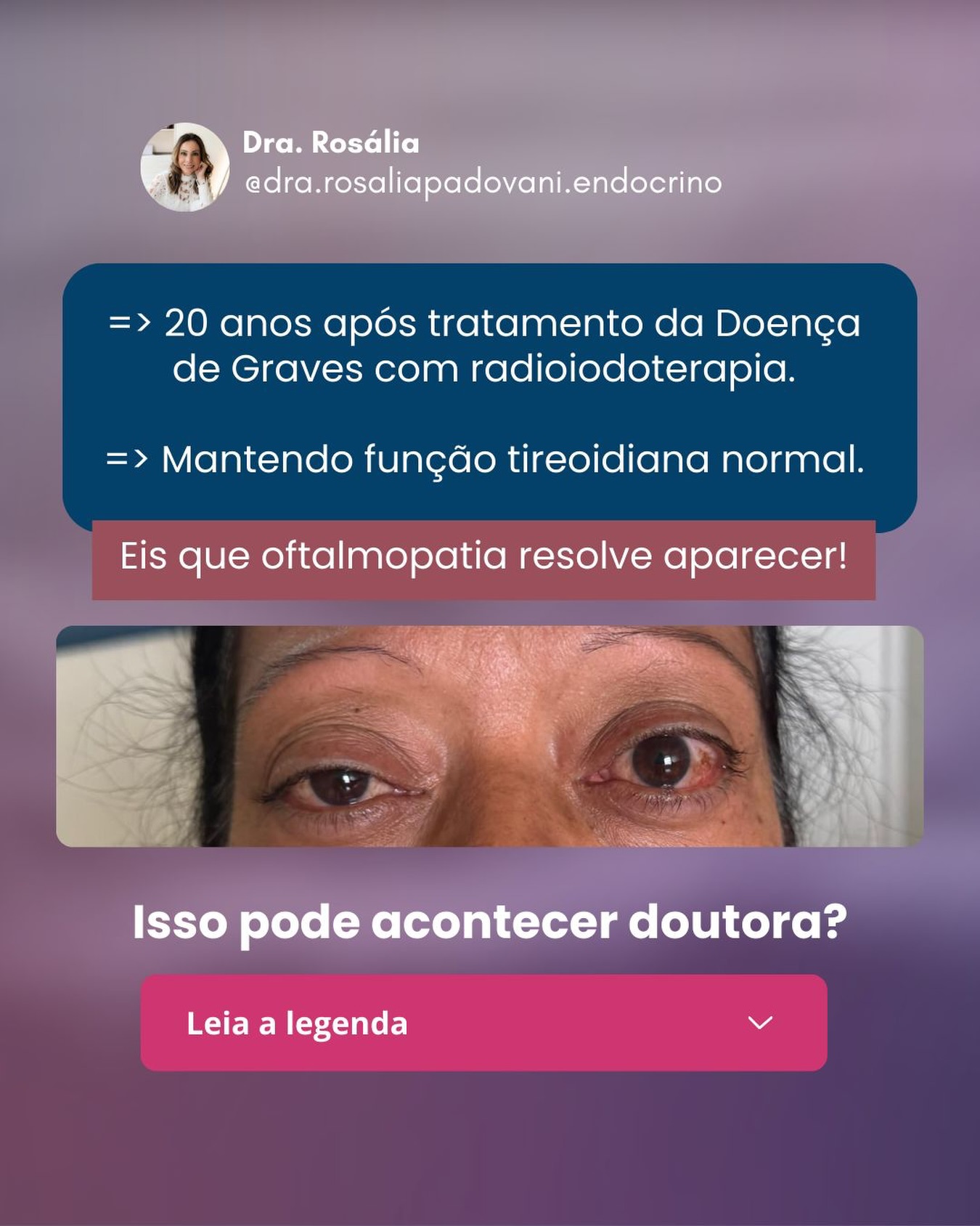 No momento, você está visualizando Oftalmopatia
